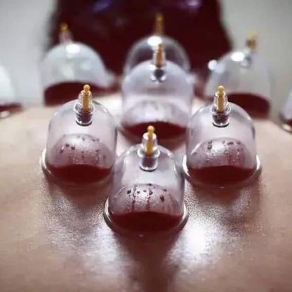 Ventouses humides - Cupping Therapy Liège