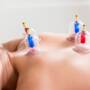 Cupping therapy - Clinique esthétique Solvay