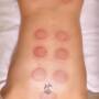 Ventouse sèche - Cupping therapy