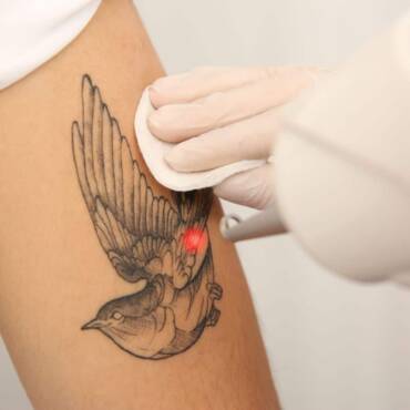 Le détatouage laser : le meilleur moyen d'enlever un tatouage
