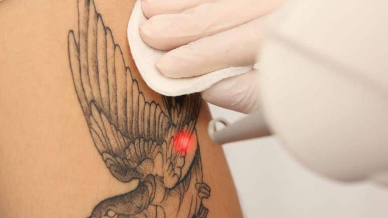 Le détatouage laser : le meilleur moyen d'enlever un tatouage